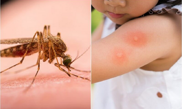 Mẹo hay giúp giảm ngứa khi bị muỗi đốt
