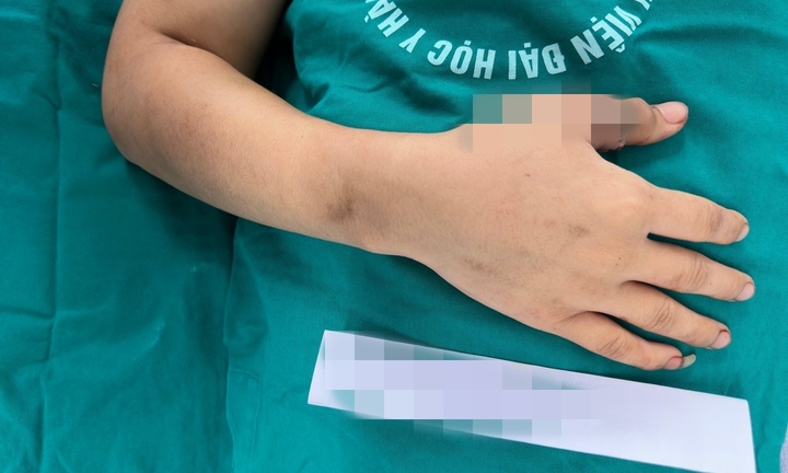 Hồi sinh ngón tay bị đứt rời cho bệnh nhi 9 tuổi