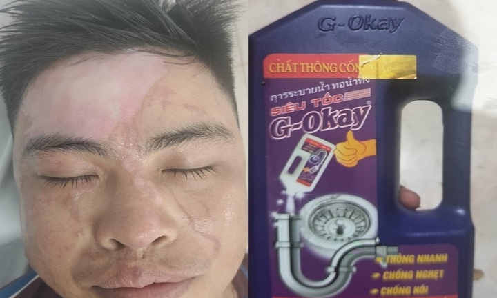 Dùng nước thông cống siêu tốc, nhiều người bỏng phải nhập viện cấp cứu