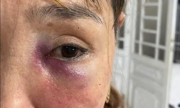 Nữ chủ quán mì Quảng bị vị khách nam hành hung bầm tím mặt