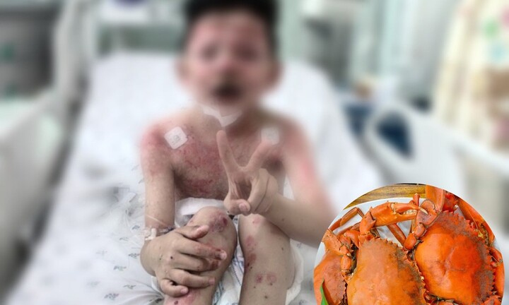 Sau 2 ngày ăn cua, bé trai nguy kịch 