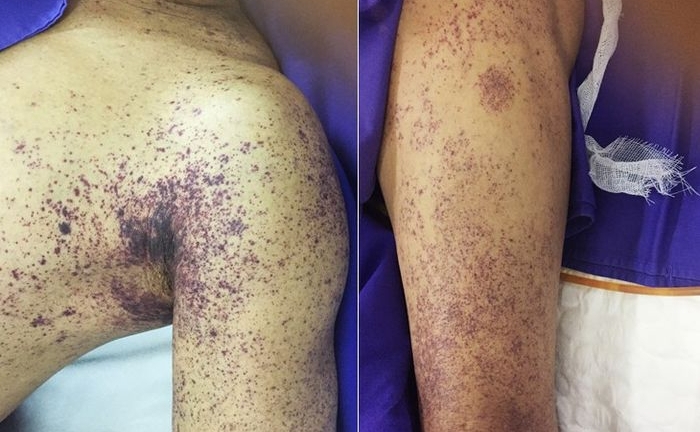 Người đàn ông ở Hà Nội tử vong sau vài ngày giết mổ lợn