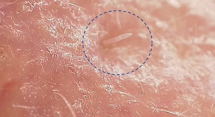 Những sinh vật kỳ quái sinh sản trên da người