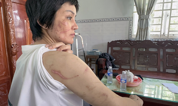 Người phụ nữ mang bầu 7 tháng bị chồng bạo hành dã man