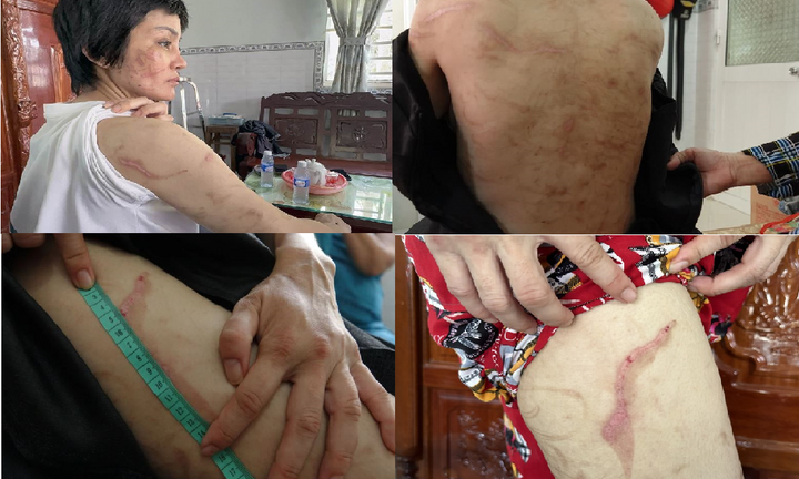 Công an tìm thấy 205 vết thương trên thân thể người vợ mang bầu 7 tháng