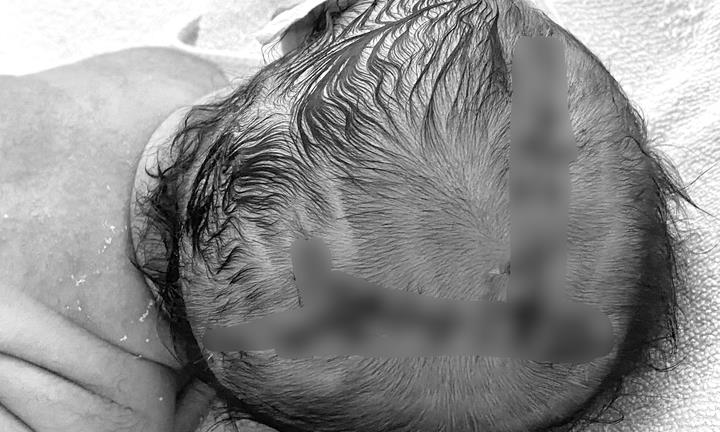 Em bé chào đời phải nhập viện khâu 21 mũi vì sai lầm của người nhà