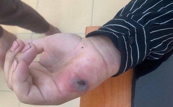 Điện Biên phát hiện 3 ổ dịch bệnh than trên người, Bộ Y tế vào cuộc