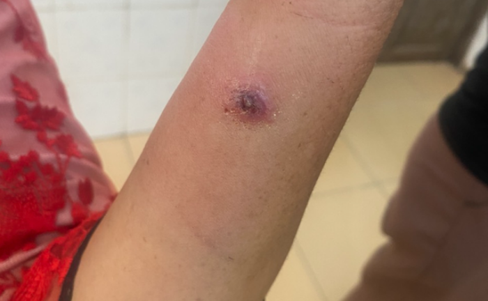 Điện Biên ghi nhận ca bệnh than thứ 14, là trẻ nhỏ 2 tuổi