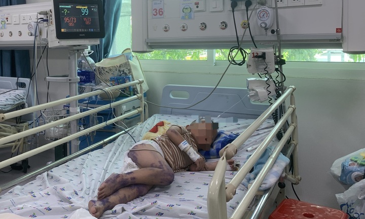 Sẽ có thuốc điều trị bệnh tay chân miệng vào tháng 7