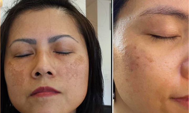 Bộ 3 sản phẩm Hi Beauty hỗ trợ mờ nám, sáng da, trả lại nét đẹp thanh xuân