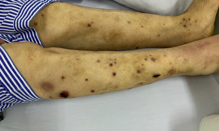 Nghe thầy lang chữa đau chân bằng cách cho ong đốt, người phụ nữ phải nhập viện 