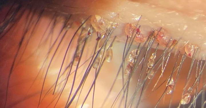 Bắt gần 100 con rận mu làm tổ trên mắt bé trai 5 tuổi