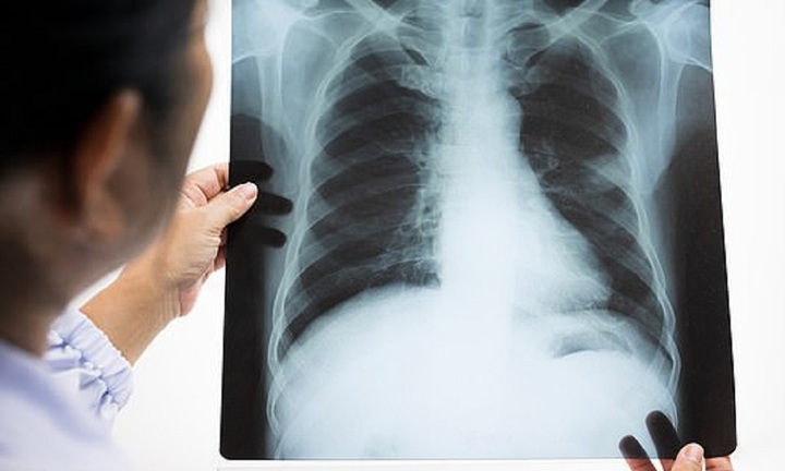 Vào viện để mổ ruột thừa, bác sĩ phát hiện thêm bệnh nguy hiểm ở phổi