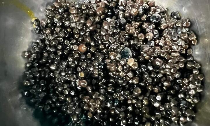 Hàng nghìn viên sỏi mật trong cơ thể cụ bà 73 tuổi