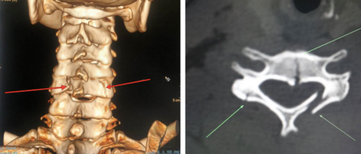 Một tháng, 10 người vào viện cấp cứu khi trèo cây hái vải