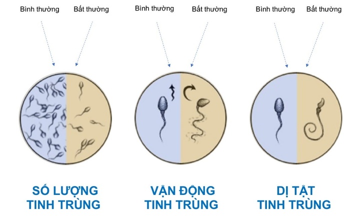 Xét nghiệm phân mảnh DNA tinh trùng, lời giải cho nhiều trường hợp vô sinh nam