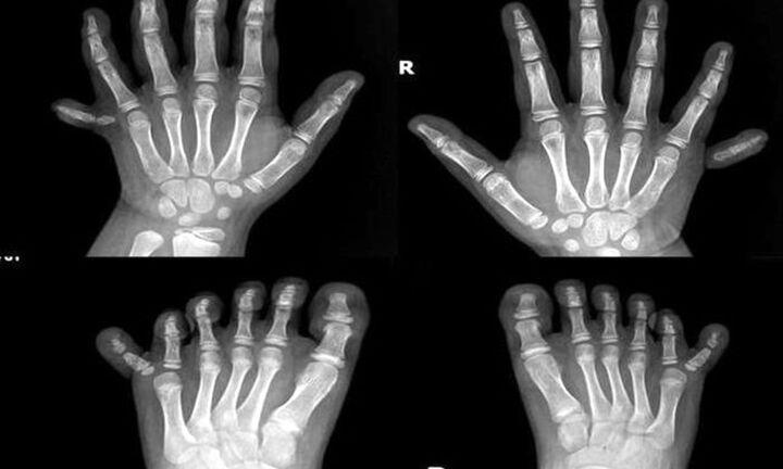 Phẫu thuật cho bé có 12 ngón tay, 12 ngón chân hiếm gặp