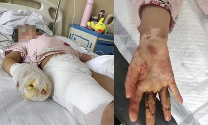 Cãi nhau với chồng, mẹ kế hành hạ con chồng đến mức tàn tật