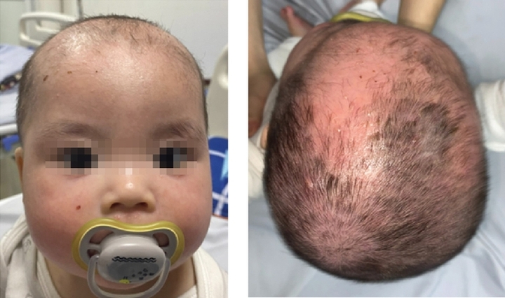 Tắm lá, bé trai bong tróc toàn bộ da mặt và đầu