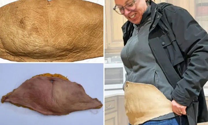 Cắt bỏ 2kg da bụng thừa, nữ nghệ sỹ đem thuộc để biến thành kỷ vật