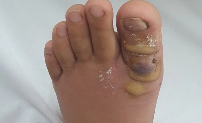 Thiếu nữ nhập viện sau khi nhổ sợi lông chân