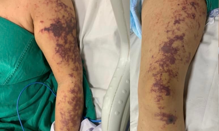 Suýt chết vì món ăn khoái khẩu của người Việt