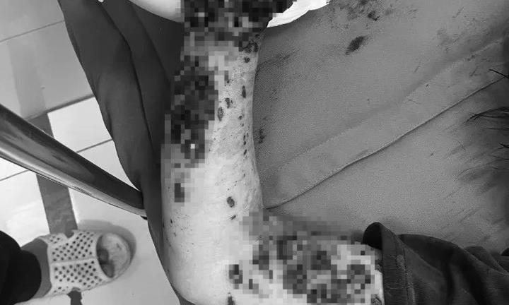 Điện thoại đang sạc phát nổ, người phụ nữ dập nát tay