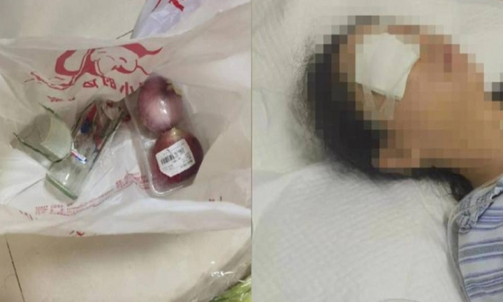 Cô gái dập nát nhãn cầu khi chai nước ngọt mua qua mạng nổ tung 