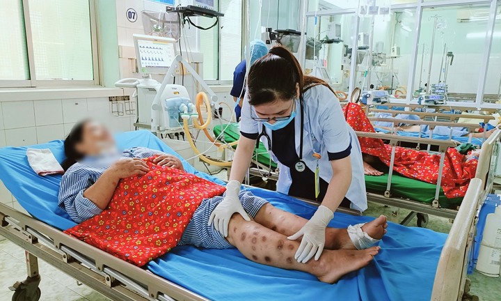 Hoại tử tay chân do tự tiêm canxi