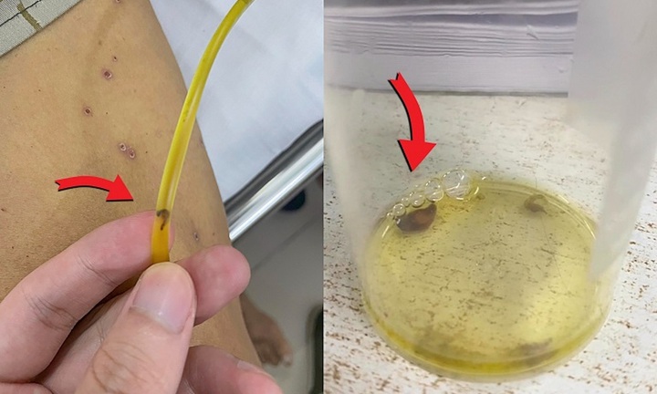 Thích ăn gỏi cá, sán lá gan chui ra từ ống dẫn lưu đường mật