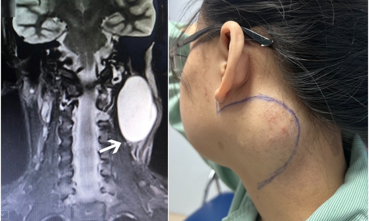 Cô gái 18 tuổi ám ảnh khối u lớn ở cổ suốt 7 năm