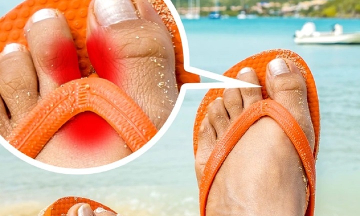 Thường xuyên đi dép xỏ ngón có hại gì?
