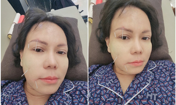 Sao Việt không may bị liệt nửa mặt, có người đứng trước nguy cơ đột quỵ