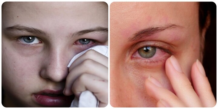 Nhìn vào mắt người đau mắt đỏ có bị lây?