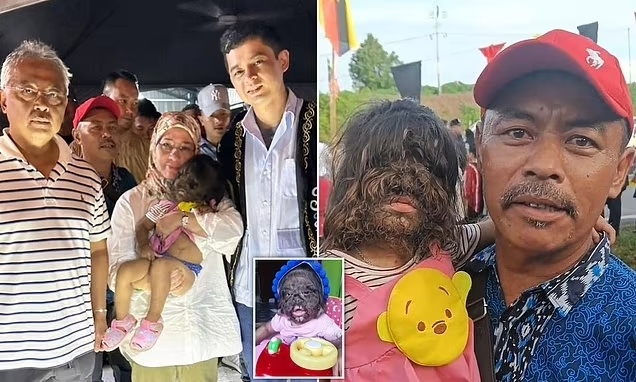 Bé gái 'người sói' được mệnh danh là 'đứa trẻ đến từ thiên đường'