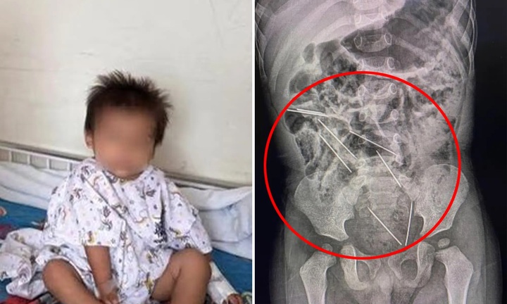 Nuốt phải 8 cây kim tiêm dành cho gia súc, cậu bé 2 tuổi may mắn được cứu