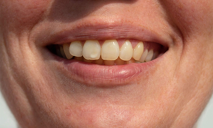 Vì sao răng có đốm trắng?