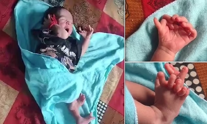 Em bé sinh ra với 26 ngón tay chân được coi là hiện thân của nữ thần Hindu