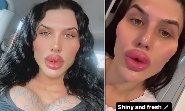 Cô gái chi gần 1,5 tỷ đồng để có đôi môi lớn nhất nước Anh