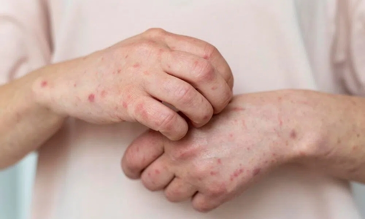 Ghi nhận 2 ca mắc đậu mùa khỉ, Bộ Y tế đề nghị xác định nguồn lây