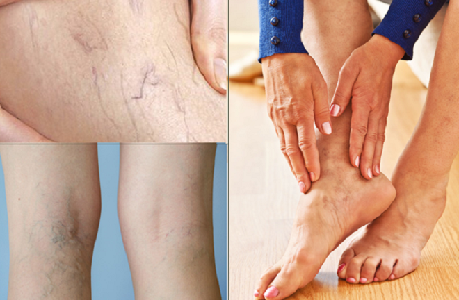 Sản phẩm từ Holistica Pháp hỗ trợ bệnh suy giãn tĩnh mạch