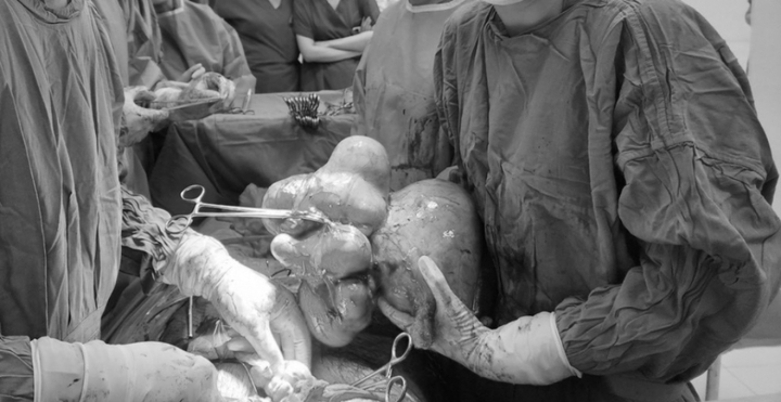 Phẫu thuật thành công ca u xơ tử cung lớn tương đương khối thai 30 tuần tuổi