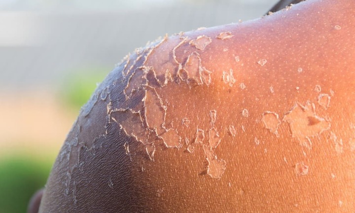 Mất bao lâu để da cháy nắng phục hồi?