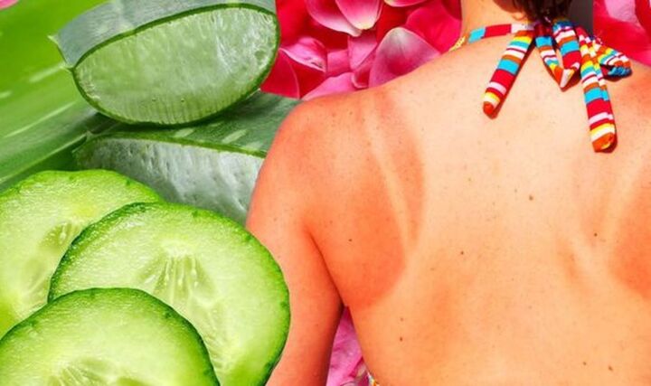 Cách điều trị da cháy nắng tại nhà