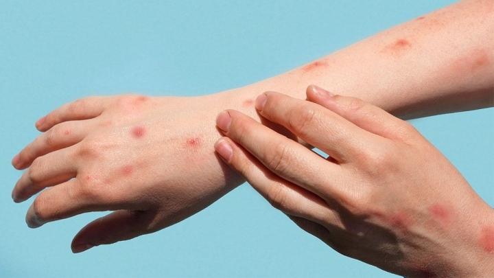 Long An ghi nhận ca đậu mùa khỉ đầu tiên