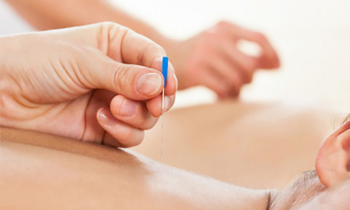 Làm đẹp, trị bệnh bằng phương pháp cấy chỉ 