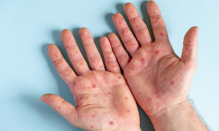 TP.HCM ghi nhận thêm 4 ca mắc đậu mùa khỉ