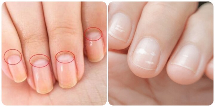 Móng tay xuất hiện đường lưỡi liềm trắng có nguy hiểm?