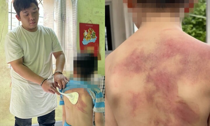 Bé trai 5 tuổi ở Đồng Nai bị cha ruột đánh dã man