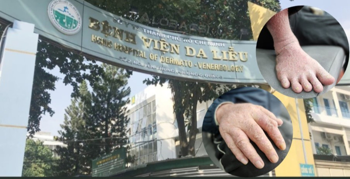 Bác sỹ hướng dẫn cách điều trị hiệu quả bệnh vảy nến